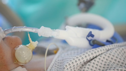 Ein beatmeter Patient liegt auf einem Krankenbett auf der Covid-19-Intensivstation im SRH Waldklinikum.