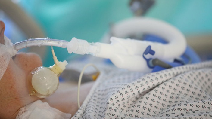 Ein beatmeter Patient liegt auf einem Krankenbett auf der Covid-19-Intensivstation im SRH Waldklinikum.
