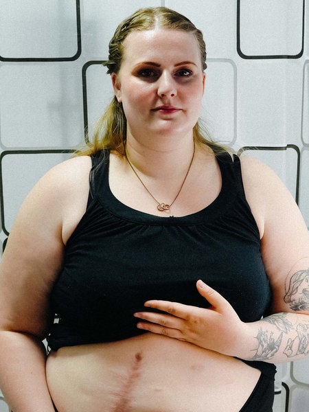 Eine Frau steht im Badezimmer neben einem Spiegel. Sie hat ihr schwarzes Top nach oben gezogen und zeigt ihre Narben am Bauch.