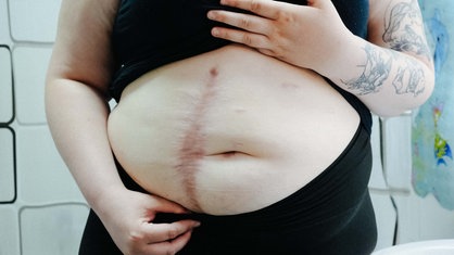 Ein Bauch mit einer Narbe von knapp unter der Brust bis Hüfthöhe.