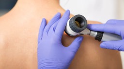 Eine Hautkrebsuntersuchung wird an einem entkleideten Oberkörper durchgeführt; Hände in blauen Handschuhen halten ein Dermatoskop an die Haut