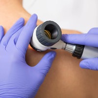Eine Hautkrebsuntersuchung wird an einem entkleideten Oberkörper durchgeführt; Hände in blauen Handschuhen halten ein Dermatoskop an die Haut