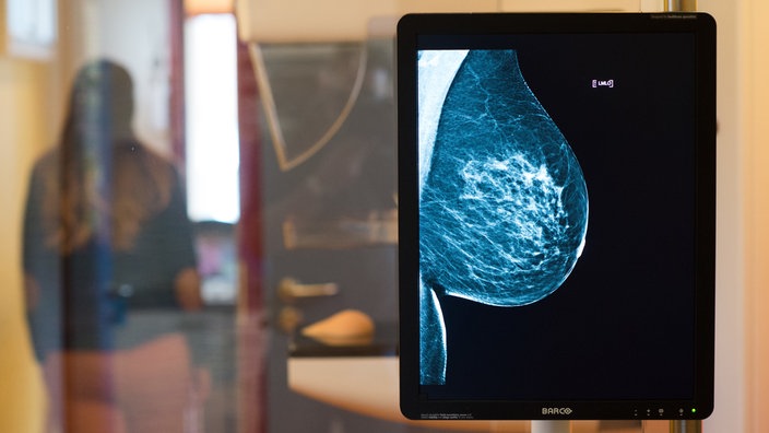 Auf einem Monitor ist die Mammographie-Aufnahme einer weiblichen Brust zu sehen