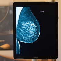 Auf einem Monitor ist die Mammographie-Aufnahme einer weiblichen Brust zu sehen